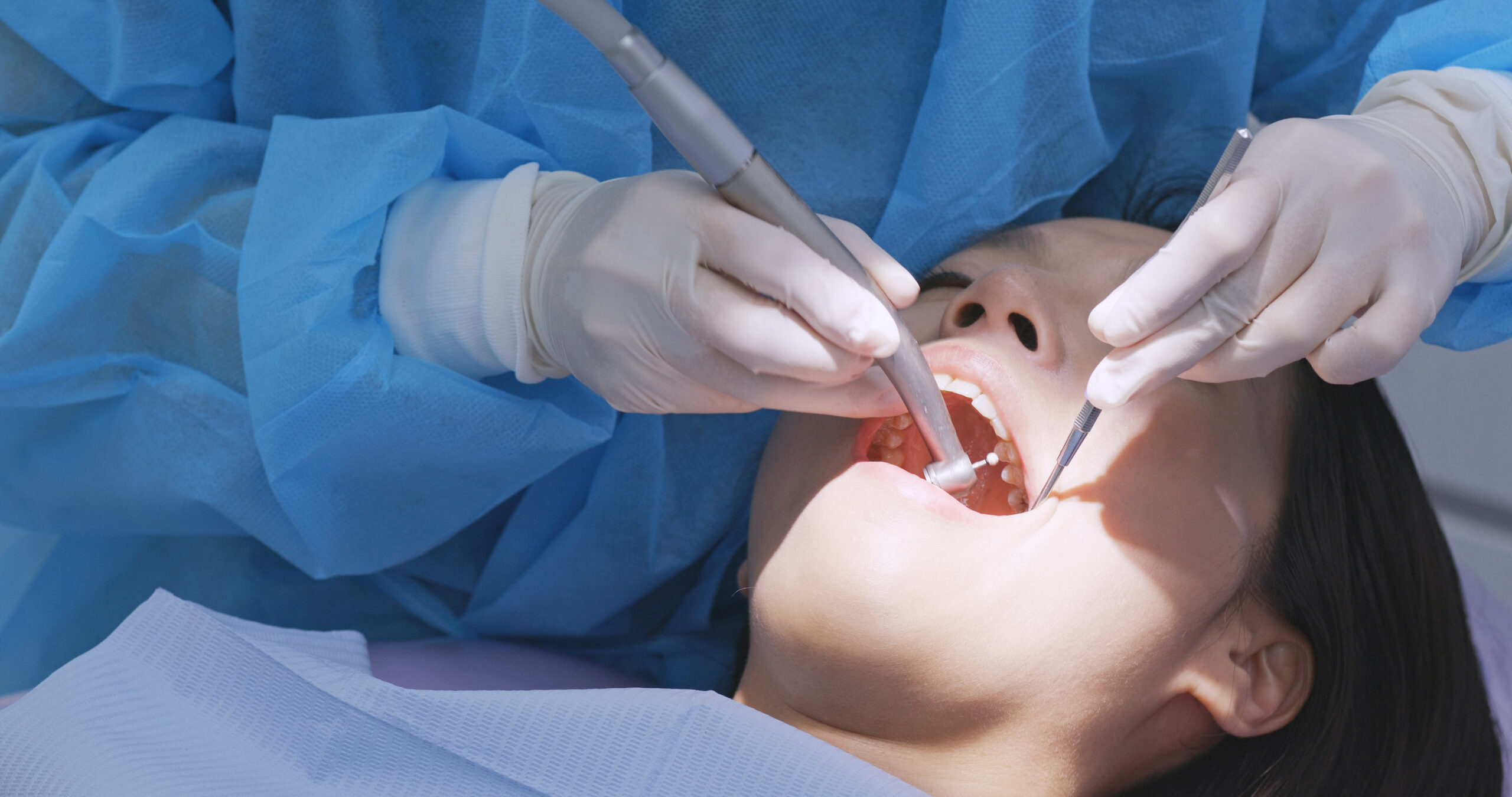 Best veneers teeth in Surat