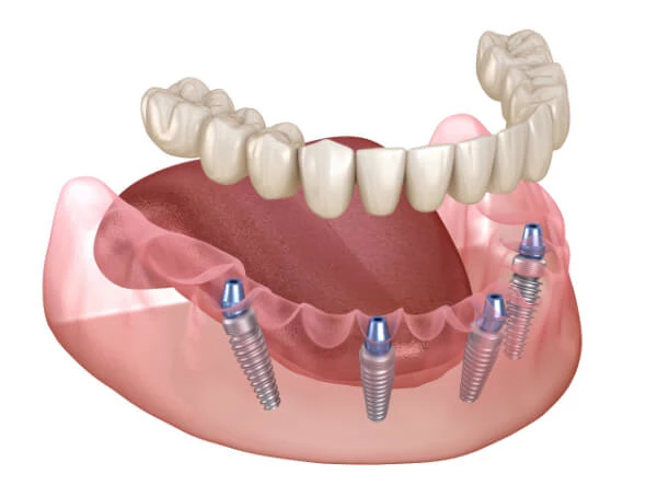 Best veneers teeth in Surat