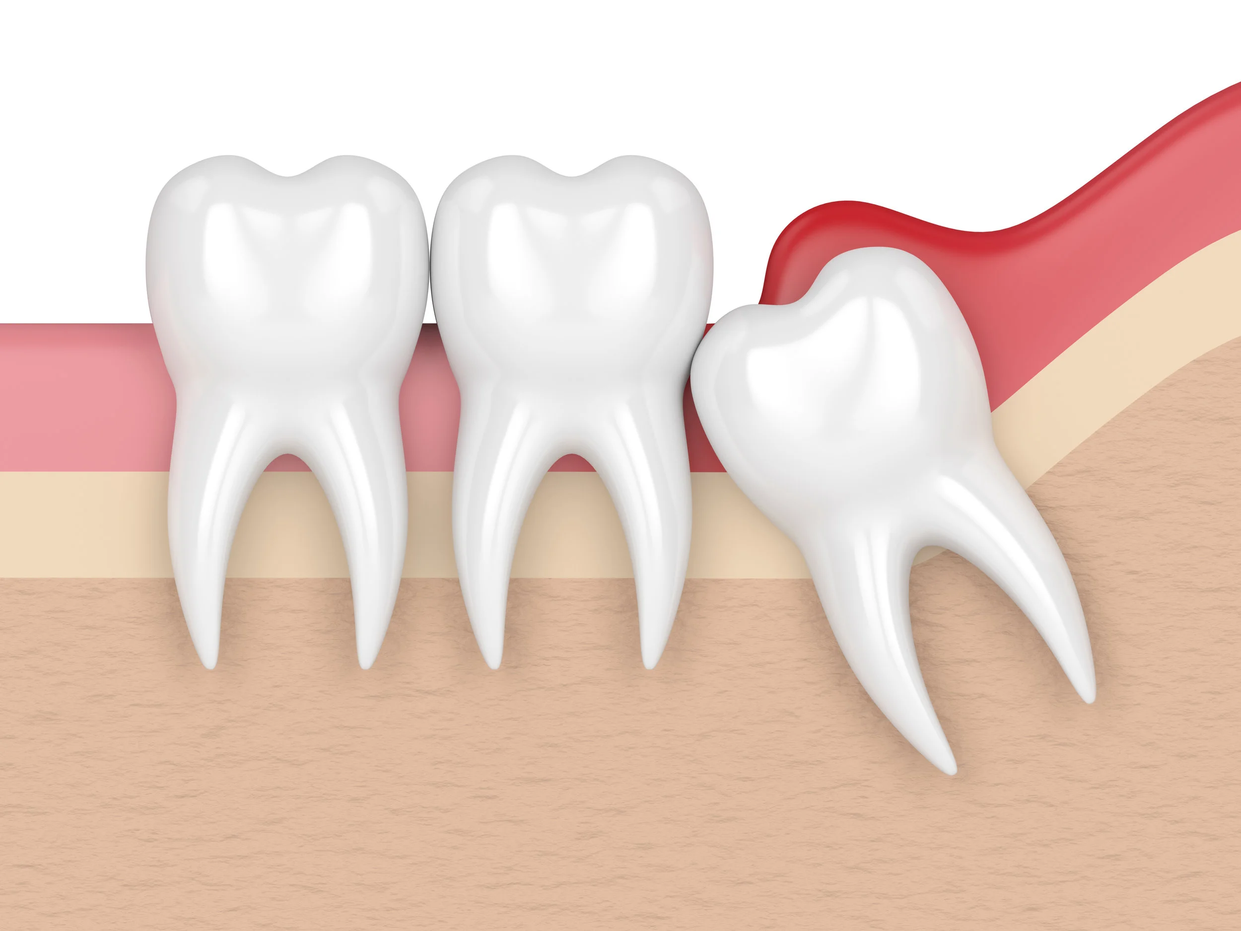 Best veneers teeth in Surat